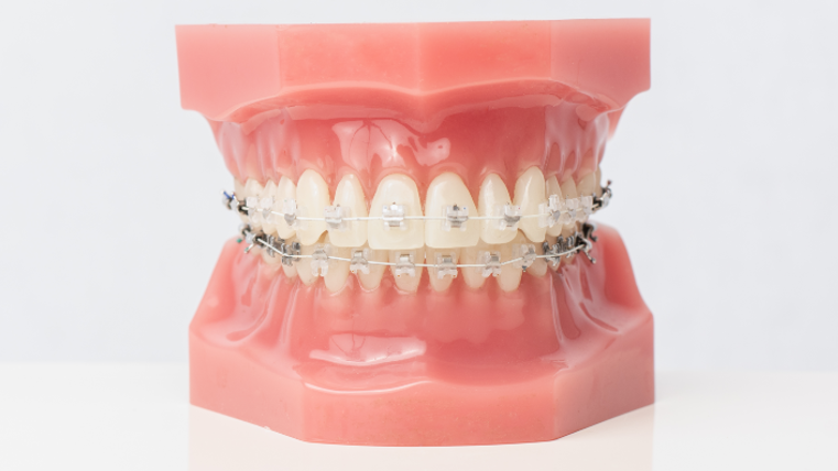 Ceramic self-ligating braces