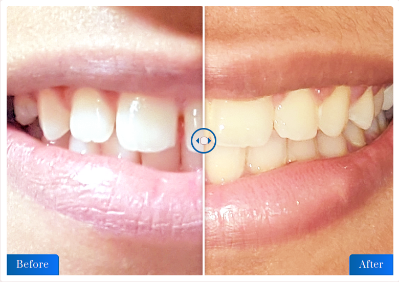 Teeth Straightening