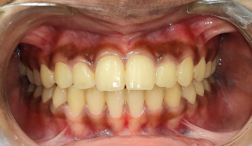 Crowded teeth inside after