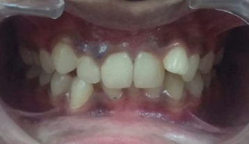 Crowded teeth inside before