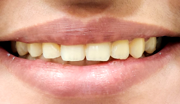 Crowded teeth smile after