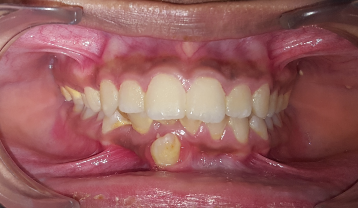 Impacted canine after inside