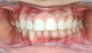 Impacted canine before inside