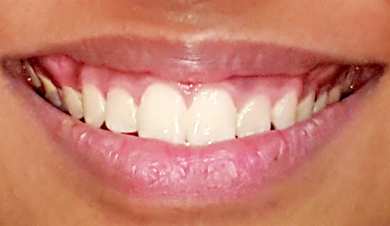 Impacted canine smile after