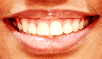 Impacted canine smile before