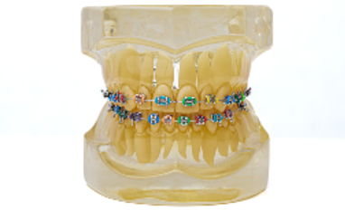 Metal Braces