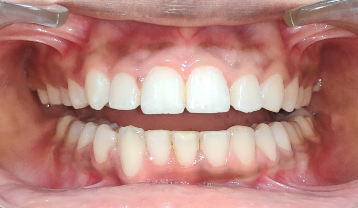 Transpositioned and Impacted Canine
