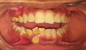 Transpositioned and Impacted Canine