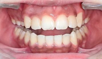 Narrow and constricted maxillary arch with severely crowded upper and lower teeth