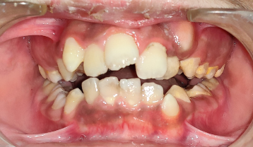 Narrow and constricted maxillary arch with severely crowded upper and lower teeth