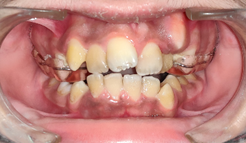 Narrow and constricted maxillary arch with severely crowded upper and lower teeth
