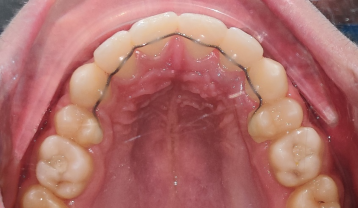 Post-Treatment crowded teeth