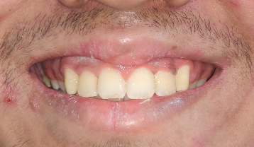 Post-Treatment crowded teeth