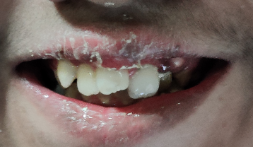 Pre-Treatment crowded teeth