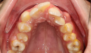 Pre-Treatment crowded teeth