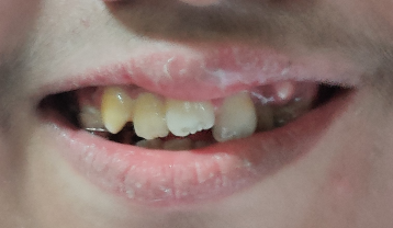 RME Appliance Mid-Treatment crowded teeth